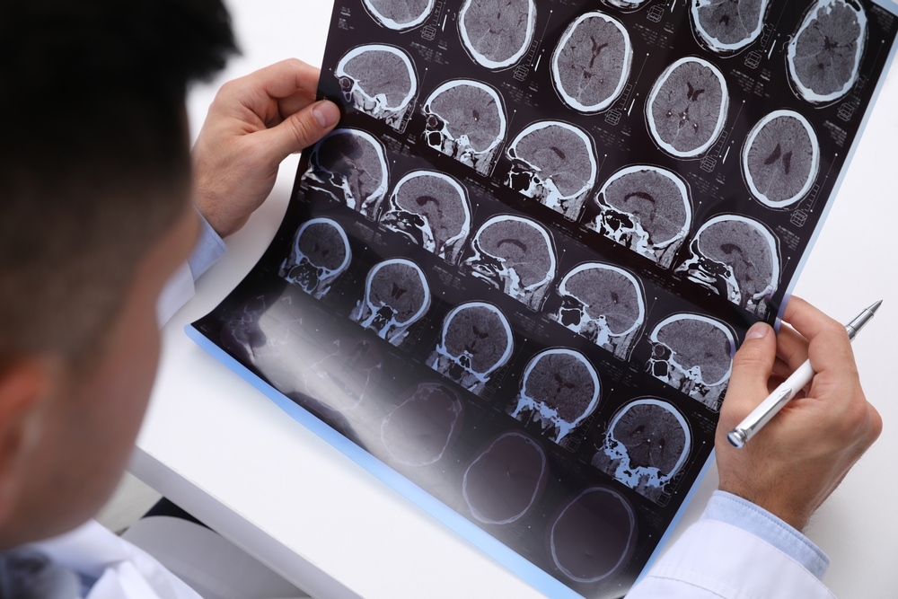 Brain Injury Attorneys in Downey, California: Why Jalilvand Law is the Right Choice