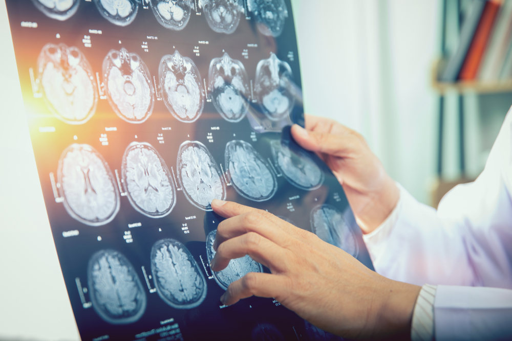 Finding the Right Brain Injury Lawyer in Pasadena, California